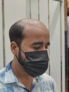 Before and After Hair Patch Transformations